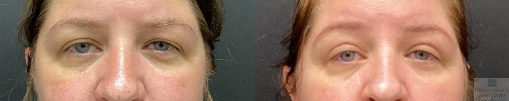 Before & After Blepharoplasty Case 58 Front View in Rochester, NY