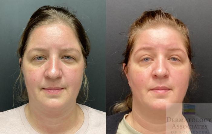 Before & After Blepharoplasty Case 58 Front View in Rochester, NY