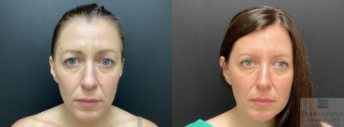 Before & After Blepharoplasty Case 62 Front View in Rochester, NY