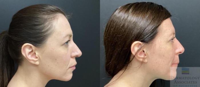 Before & After Blepharoplasty Case 62 Right Side View in Rochester, NY