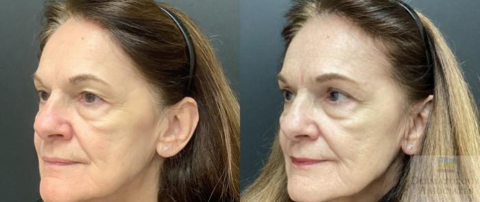 Before & After Blepharoplasty Case 72 Left Side View in Rochester, NY