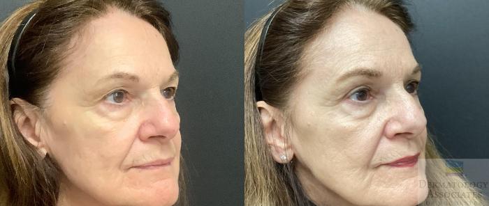 Before & After Blepharoplasty Case 72 Right Side View in Rochester, NY