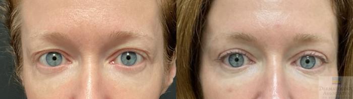 Before & After Blepharoplasty Case 79 Front View in Rochester, NY