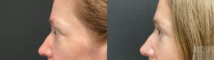 Before & After Blepharoplasty Case 79 Left Side View in Rochester, NY