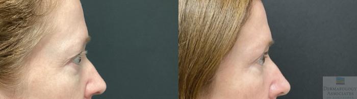 Before & After Blepharoplasty Case 79 Right Side View in Rochester, NY