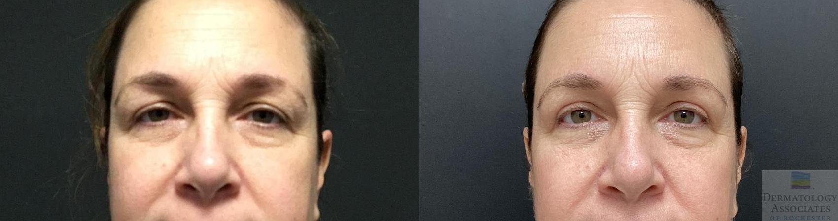 Before & After Blepharoplasty Case 82 Front View in Rochester, NY
