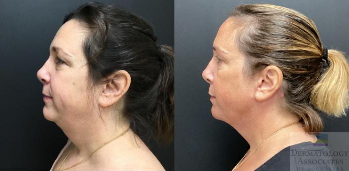 Before & After Blepharoplasty Case 82 Left Side View in Rochester, NY