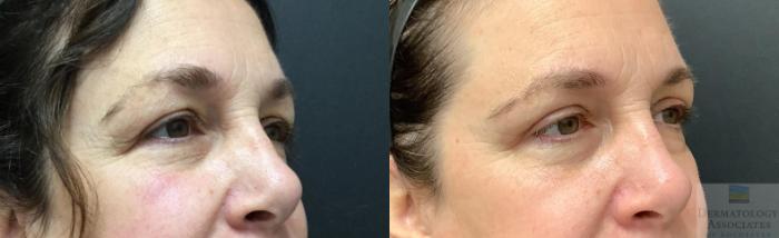 Before & After Blepharoplasty Case 82 Right Side View in Rochester, NY