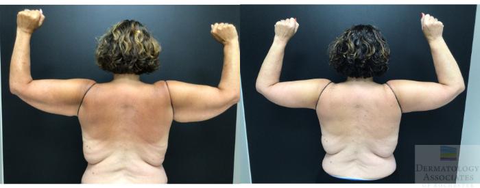Before & After Brachioplasty - arm lift Case 14 Back View in Rochester, NY