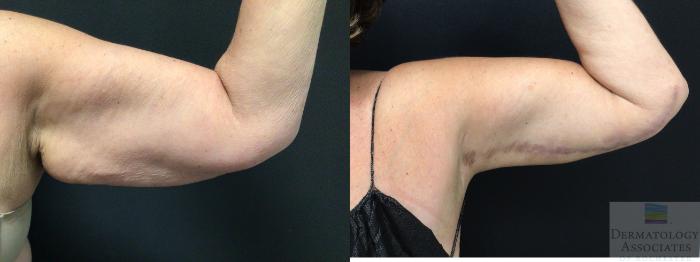 Before & After Brachioplasty - arm lift Case 14 Left Side View in Rochester, NY