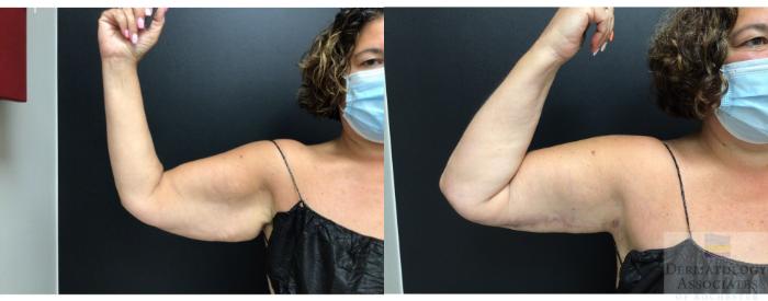 Before & After Brachioplasty - arm lift Case 14 Right Side View in Rochester, NY