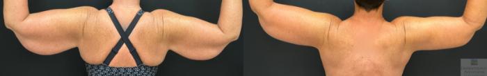 Before & After Brachioplasty - arm lift Case 144 Back View in Rochester, NY