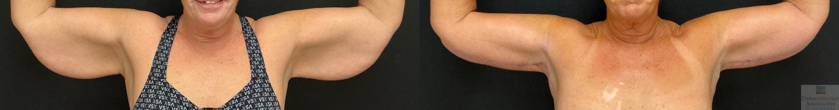 Before & After Brachioplasty - arm lift Case 144 Front View in Rochester, NY