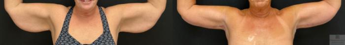 Before & After Brachioplasty - arm lift Case 144 Front View in Rochester, NY