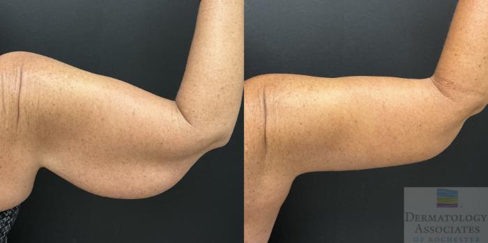 Before & After Brachioplasty - arm lift Case 144 Right Oblique View in Rochester, NY
