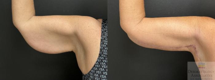 Before & After Brachioplasty - arm lift Case 144 Right Side View in Rochester, NY