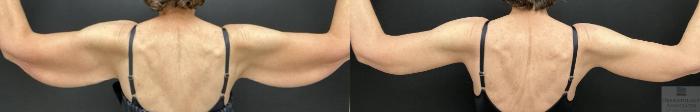 Before & After Brachioplasty - arm lift Case 98 Back View in Rochester, NY