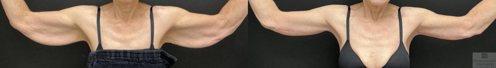 Before & After Brachioplasty - arm lift Case 98 Front View in Rochester, NY