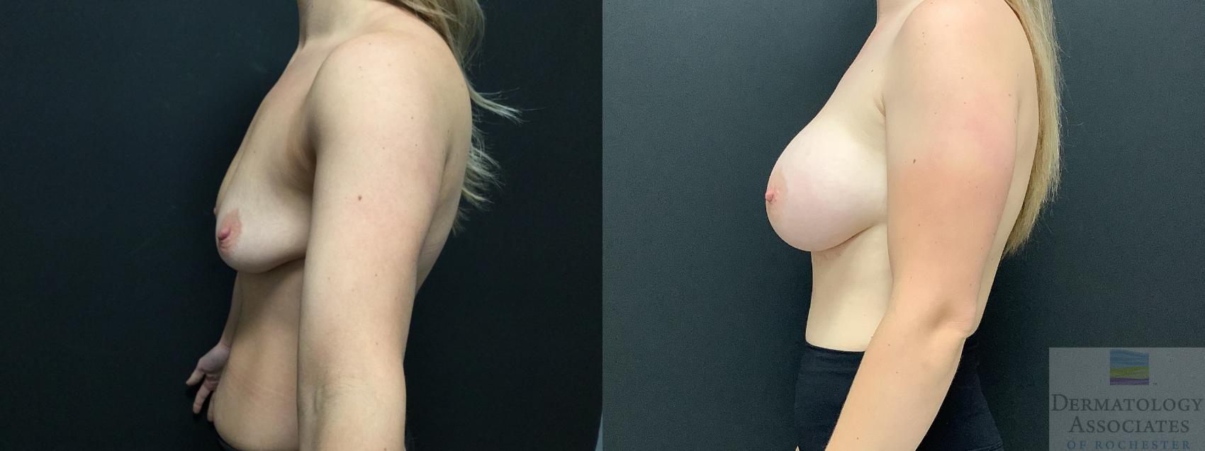 Before & After Breast Augmentation Case 1 Left Side View in Rochester, NY