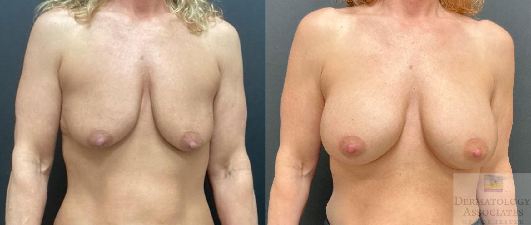 Before & After Breast Augmentation Case 119 Front View in Rochester, NY