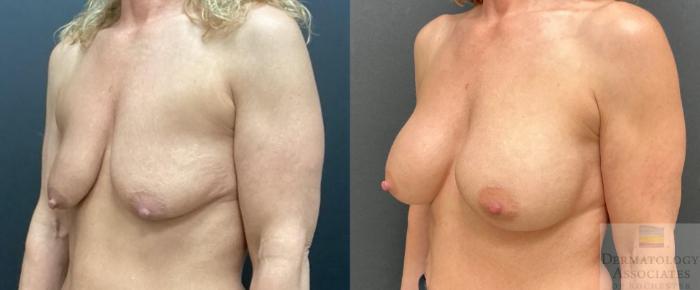 Before & After Breast Augmentation Case 119 Left Angle View in Rochester, NY