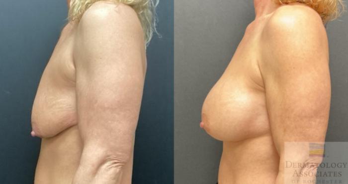 Before & After Breast Augmentation Case 119 Left Side View in Rochester, NY