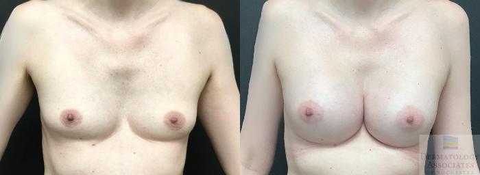 Before & After Breast Augmentation Case 120 Front View in Rochester, NY