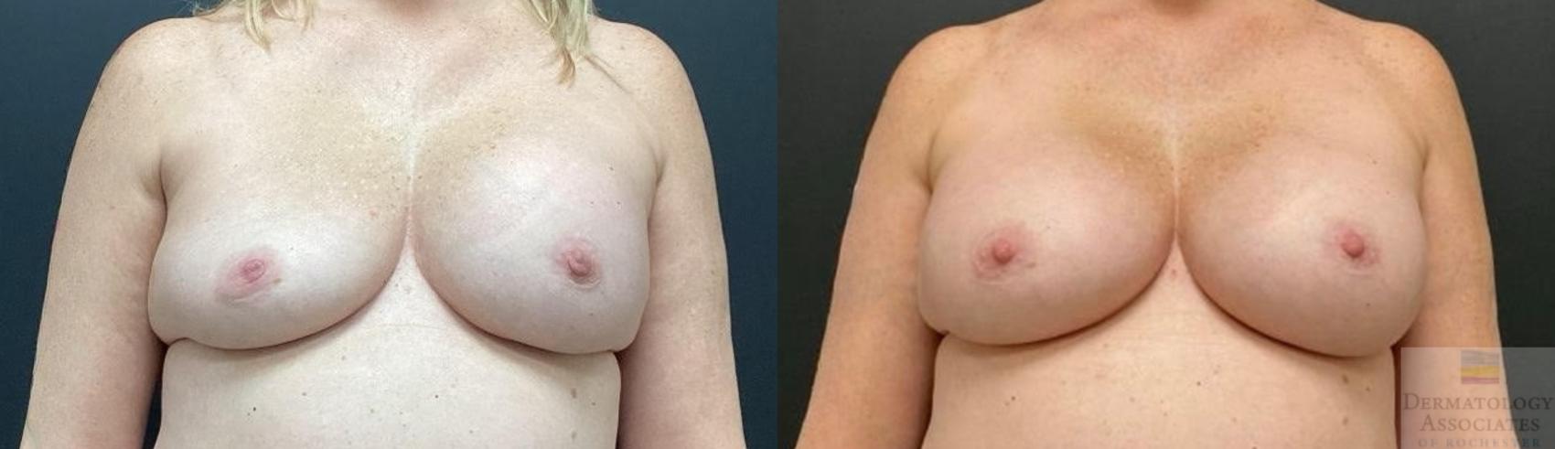 Before & After Breast Augmentation Case 122 Front View in Rochester, NY