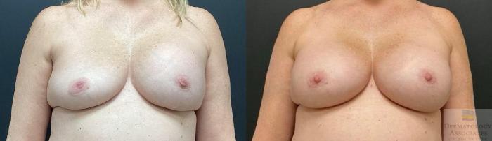 Before & After Breast Augmentation Case 122 Front View in Rochester, NY