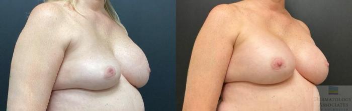 Before & After Breast Augmentation Case 122 Right Side Angle View in Rochester, NY