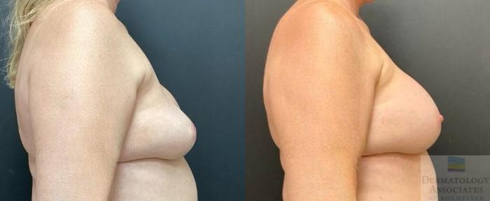 Before & After Breast Augmentation Case 122 Right Side View in Rochester, NY