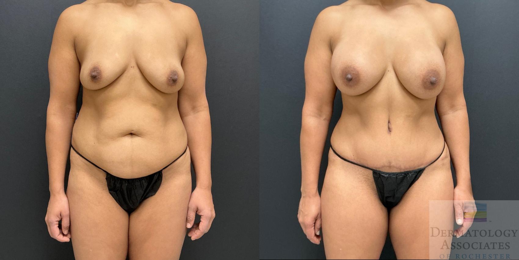 Before & After Breast Augmentation Case 126 Front View in Rochester, NY
