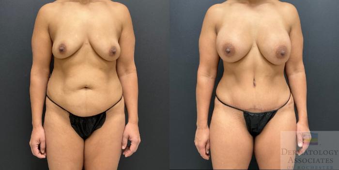 Before & After Breast Augmentation Case 126 Front View in Rochester, NY
