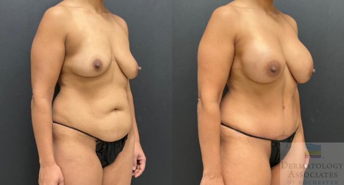 Before & After Breast Augmentation Case 126 Right Oblique View in Rochester, NY