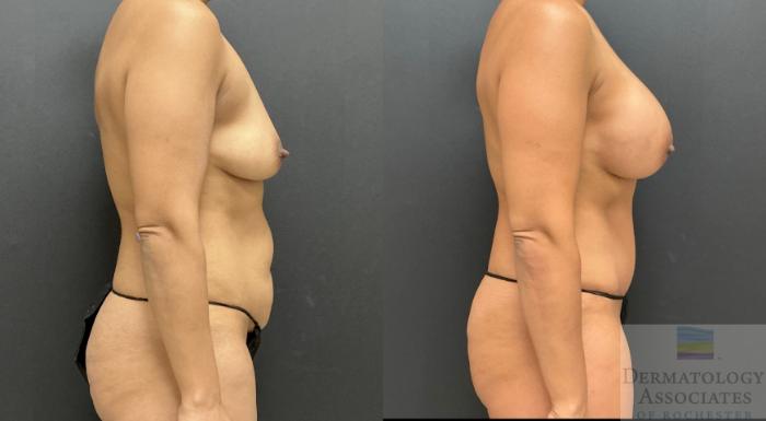 Before & After Breast Augmentation Case 126 Right Side View in Rochester, NY