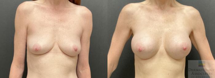 Before & After Breast Augmentation Case 131 Front View in Rochester, NY