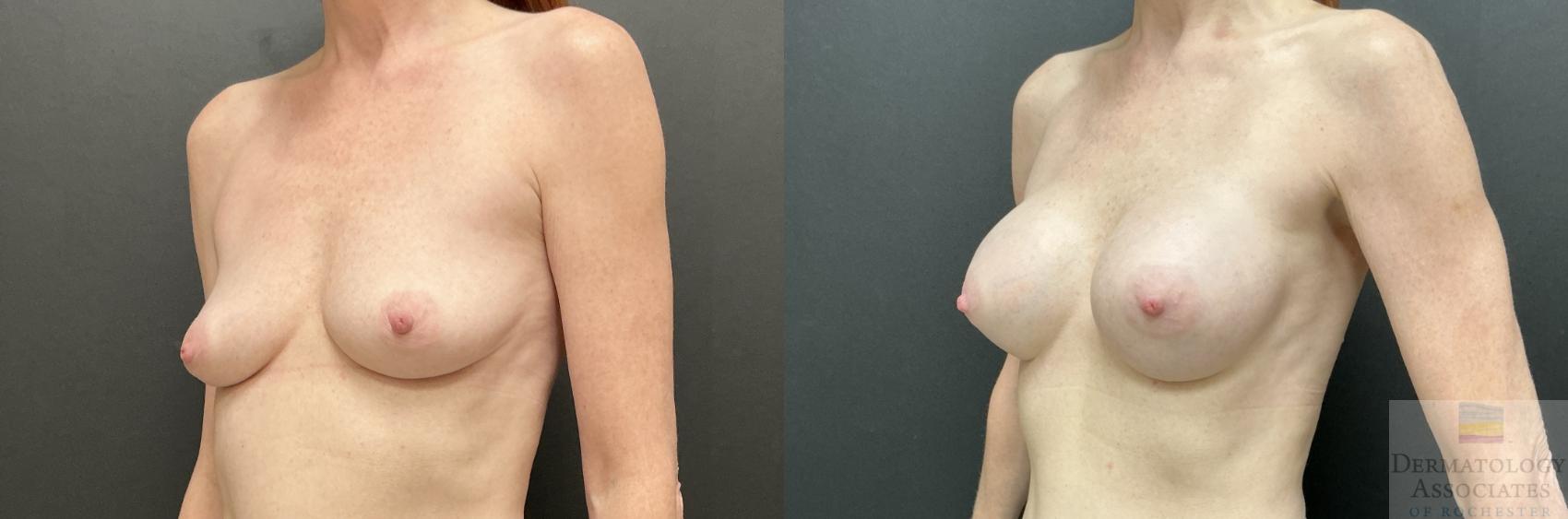 Before & After Breast Augmentation Case 131 Left Angle View in Rochester, NY