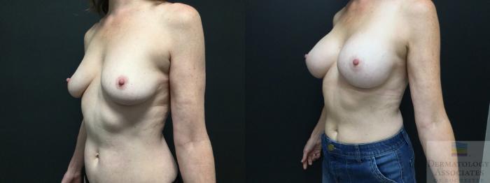 Before & After Breast Augmentation Case 2 Left Oblique View in Rochester, NY