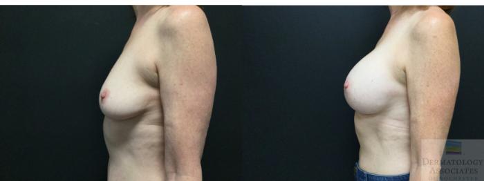 Before & After Breast Augmentation Case 2 Left Side View in Rochester, NY