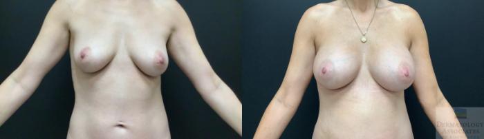 Before & After Breast Augmentation Case 3 Front View in Rochester, NY