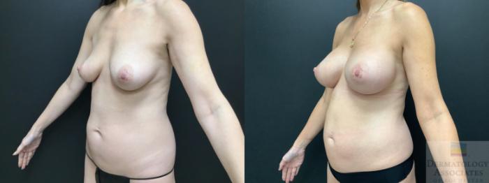 Before & After Breast Augmentation Case 3 Left Oblique View in Rochester, NY