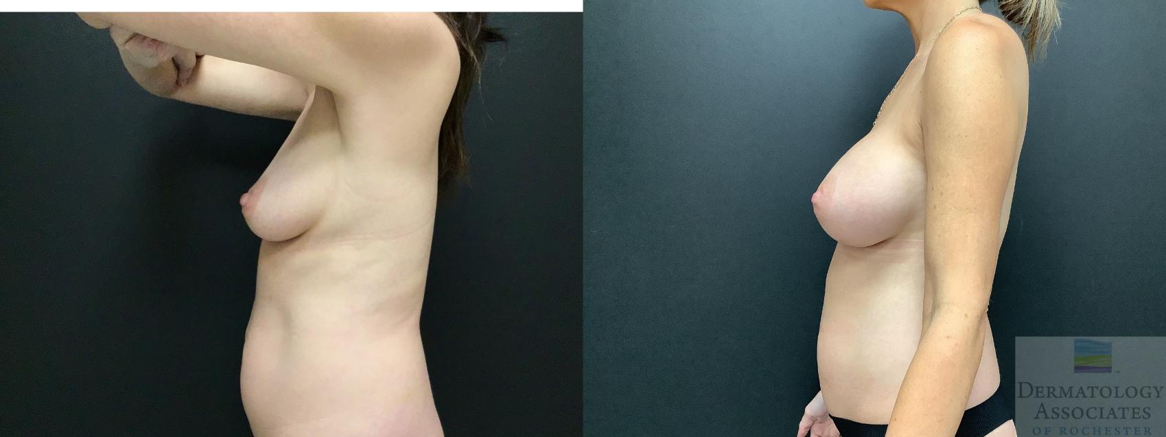 Before & After Breast Augmentation Case 3 Left Side View in Rochester, NY