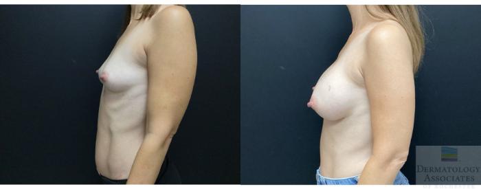 Before & After Breast Augmentation Case 39 Left Side View in Rochester, NY