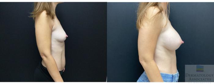 Before & After Breast Augmentation Case 39 Right Side View in Rochester, NY