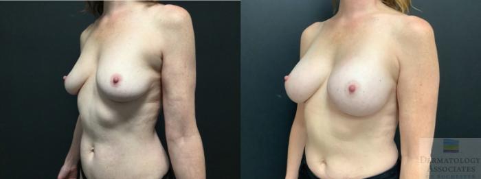 Before & After Breast Augmentation Case 42 45 Degree Angle View in Rochester, NY