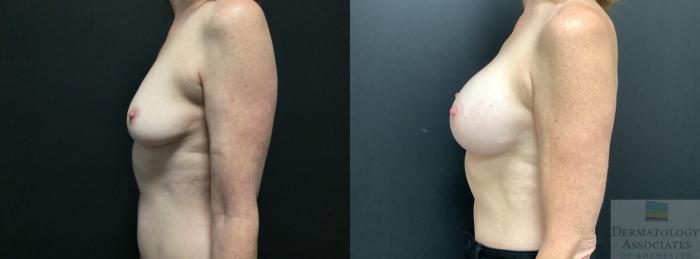 Before & After Breast Augmentation Case 42 Left Side View in Rochester, NY