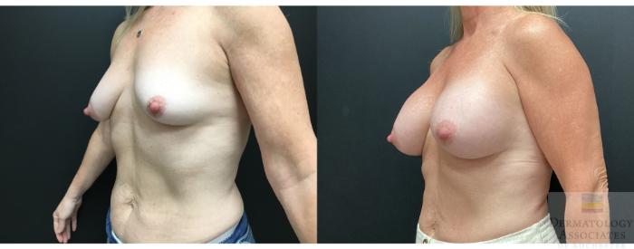 Before & After Breast Augmentation Case 48 45 Degree Angle View in Rochester, NY