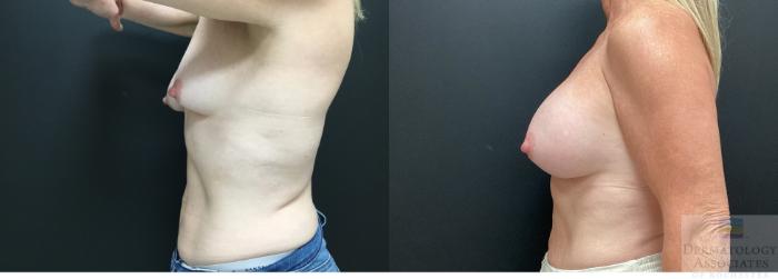 Before & After Breast Augmentation Case 48 Left Side View in Rochester, NY