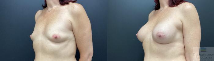 Before & After Breast Augmentation Case 54 Angle View in Rochester, NY