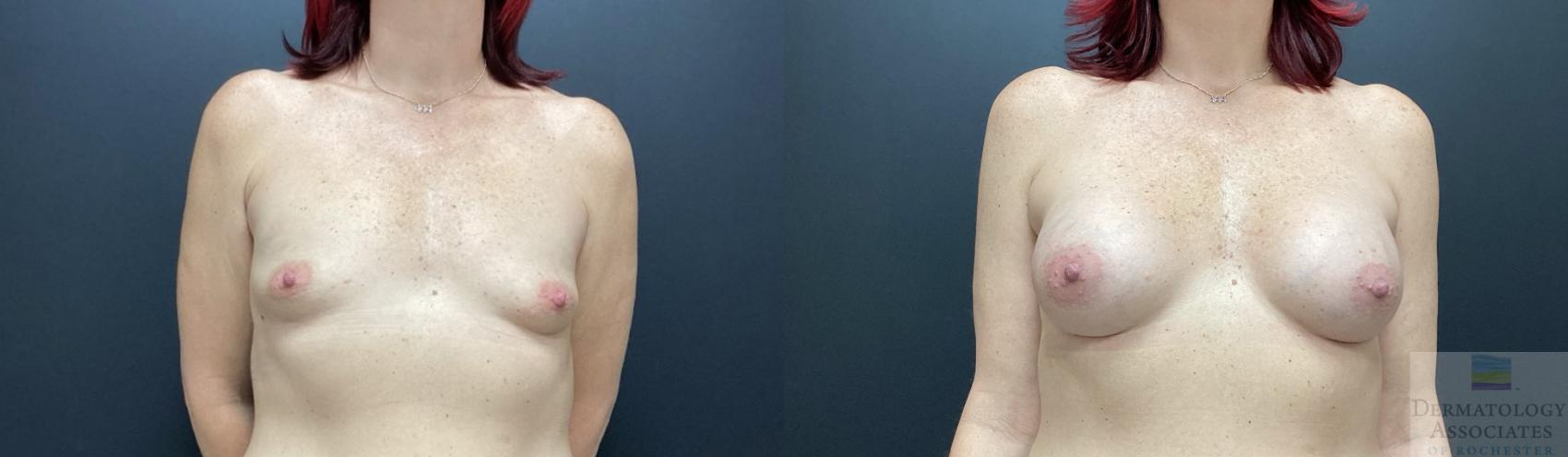 Before & After Breast Augmentation Case 54 Front View in Rochester, NY